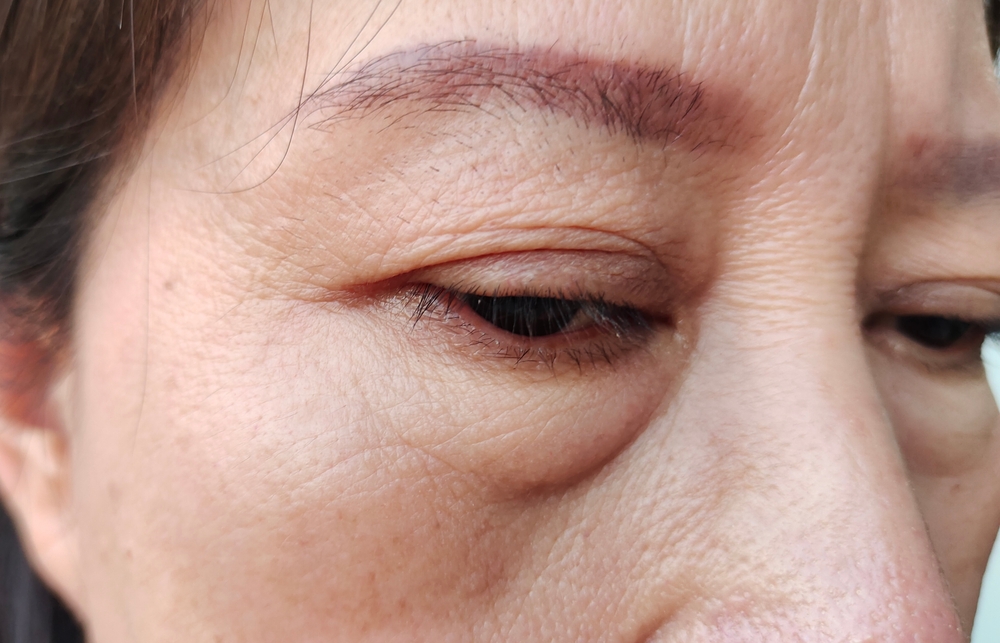 Follow These 5 Blepharoplasty Recovery Tips For a Quick Healing