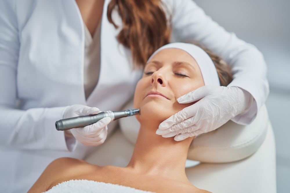 5 Benefits of the Best Microneedling Results in Fairfax