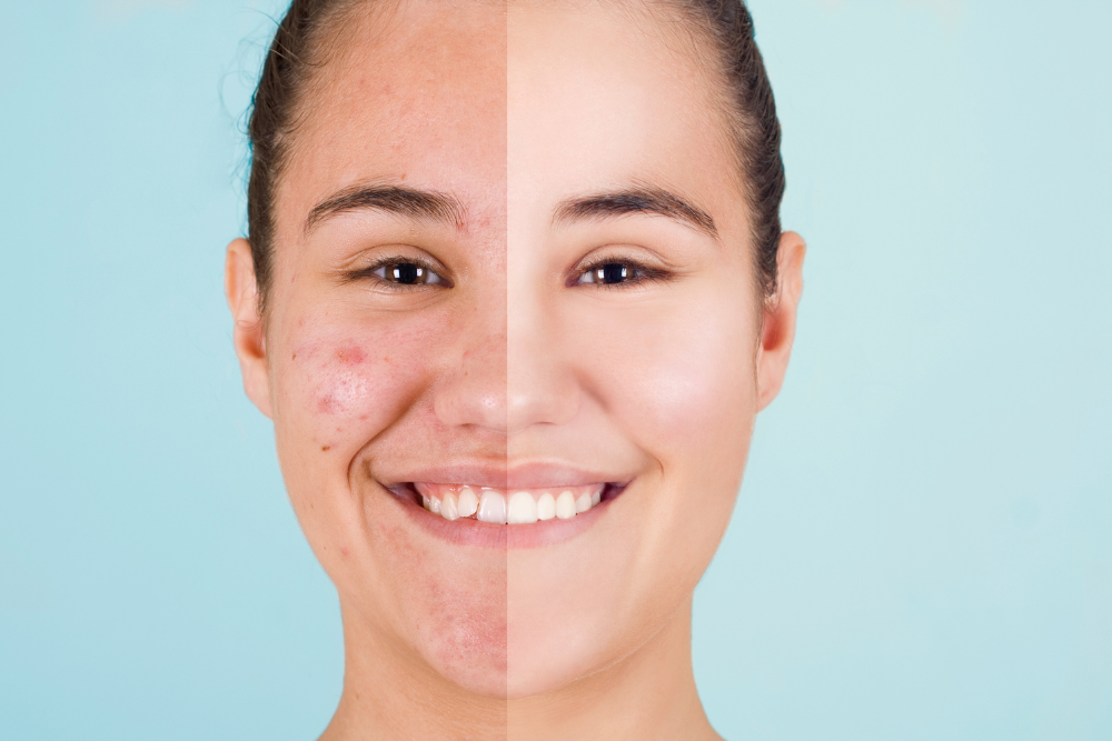 Best Chemical Peels for Acne in Fairfax