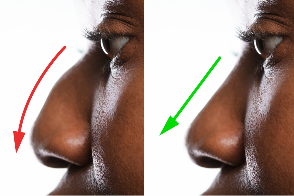 African American Nose Job Surgery in Virginia