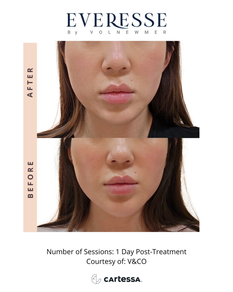 Everesse Skin Tightening in Northern Virginia